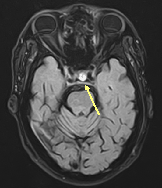MRI MRI đầu