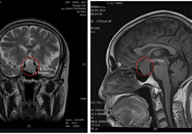 phat-hien-som-dot-quy-ung-thu-bang-chup-mri-mri-dwibs-toan-than